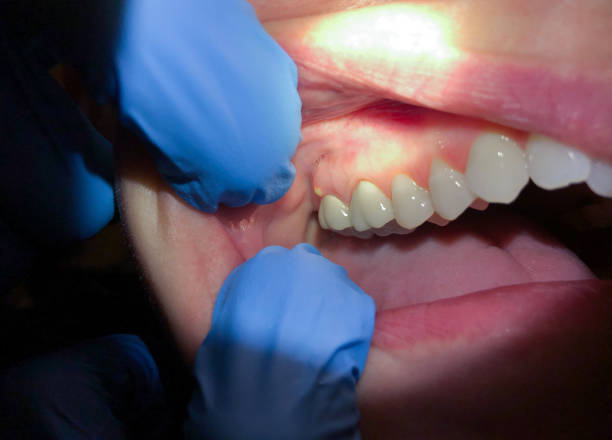 Best Emergency Dental Care for Sports Injuries in Wetumka, OK